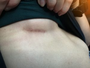 Cicatrizes e cuidados: O que você precisa saber sobre a cicatriz de implantes mamários